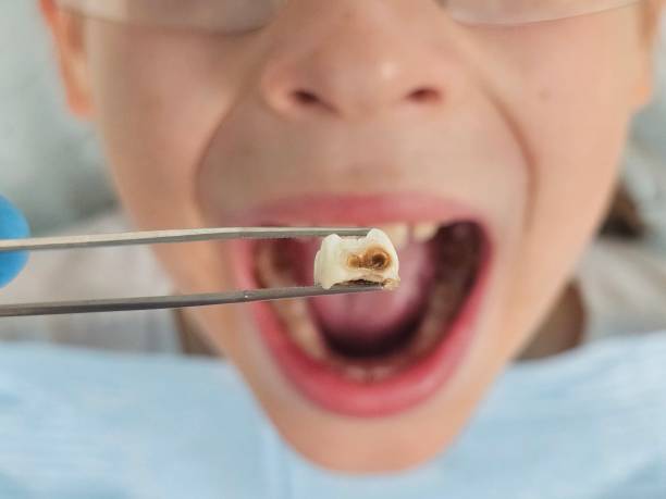 Best Emergency Dental Care for Sports Injuries in Larksville, PA